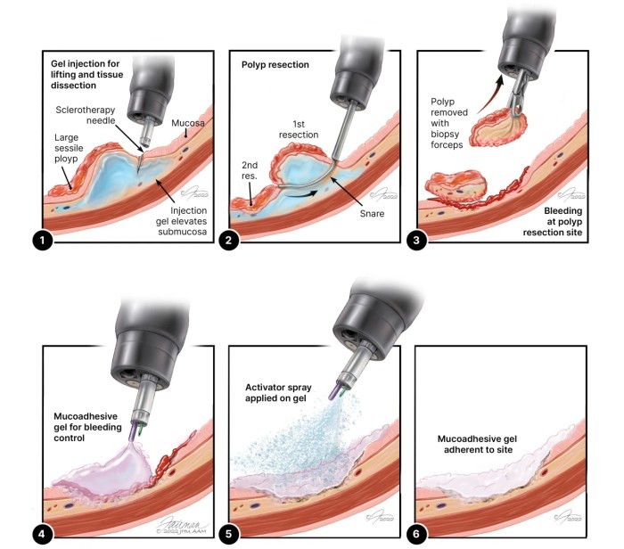 Colonoscopy polyp removal